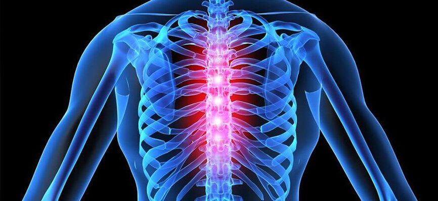Akut ağrı, torasik omurganın osteokondrozunun alevlenmesinin karakteristiğidir