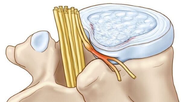 Torasik osteokondrozda ortaya çıkan intervertebral diskin çıkıntıları sinir uçlarını sıkıştırır