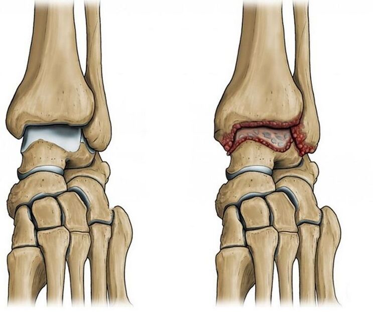 ayak bileği ekleminin osteoartriti
