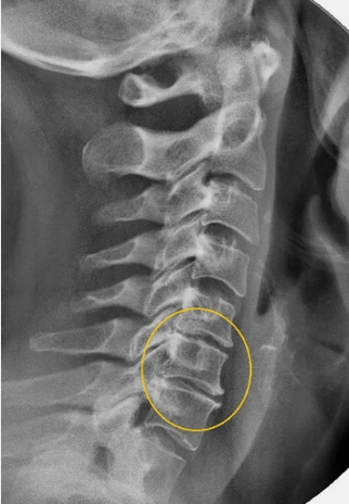 Bir X -Ray'de servikal omurganın osteokondrozu