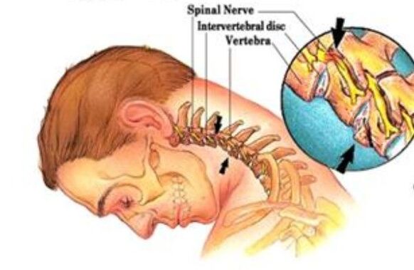 servikal osteokondroz
