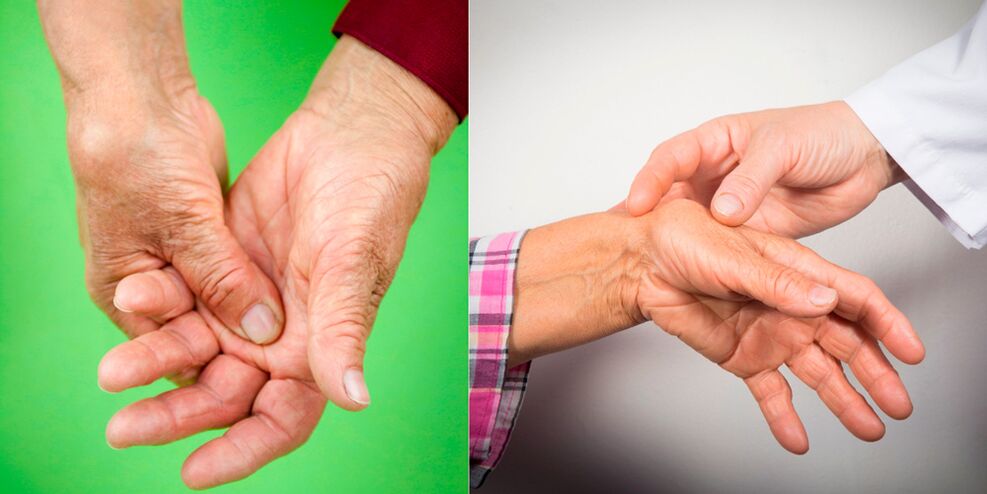 şişme ve ağrıyan ağrılar el artritinin ilk belirtileridir