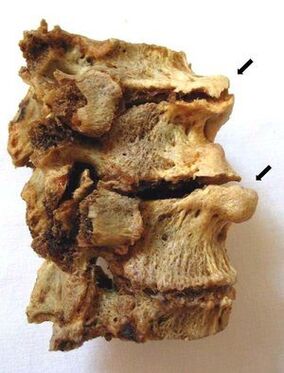 Osteokondrozdan etkilenen vertebral bölüm
