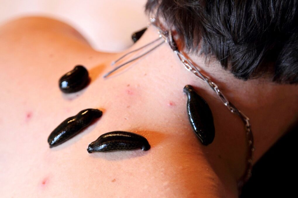 servikal osteokondroz için sülükler